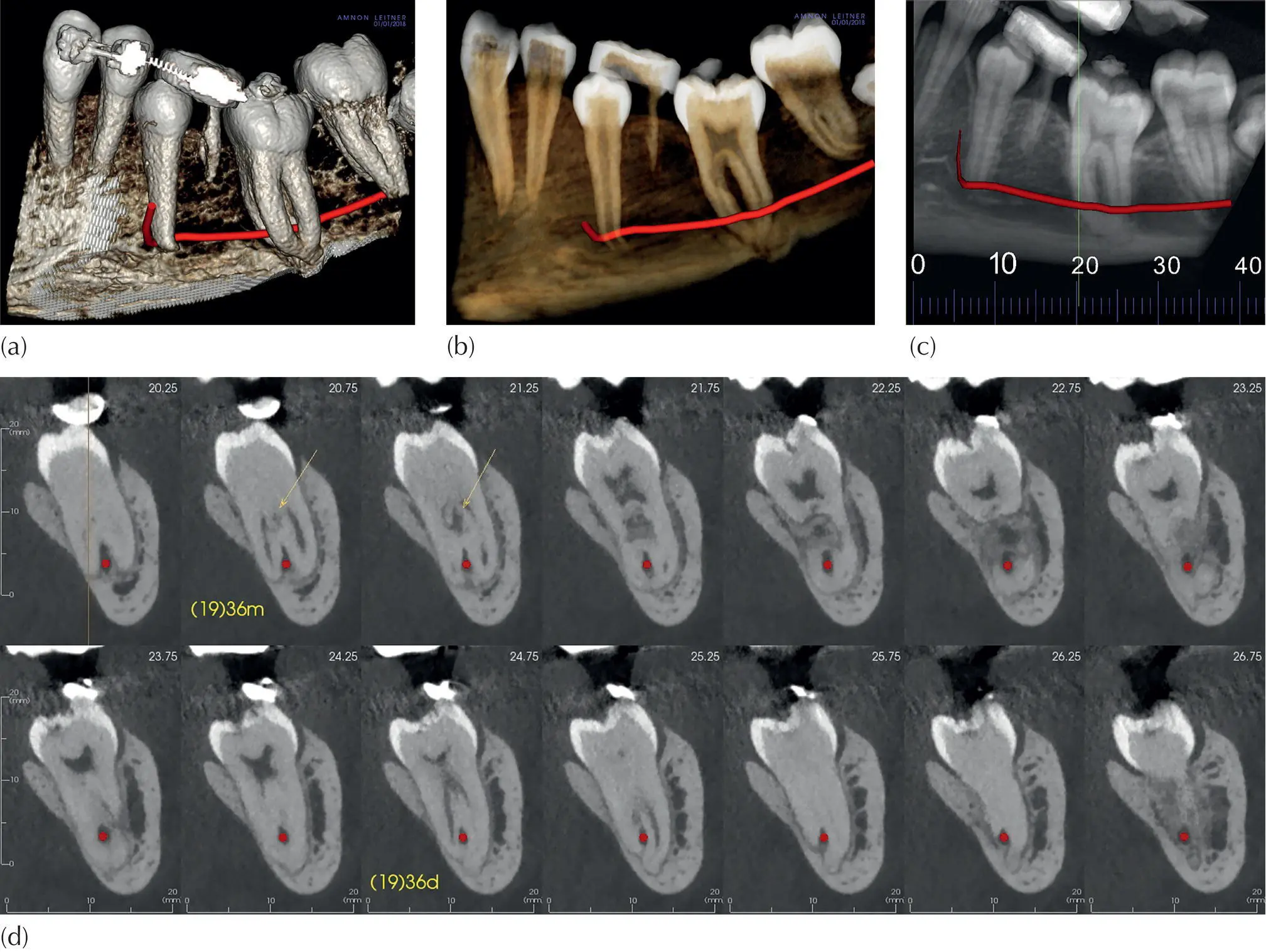 Fig 420 First mandibular molar embracing inferior dental canal a 3D bony - фото 58