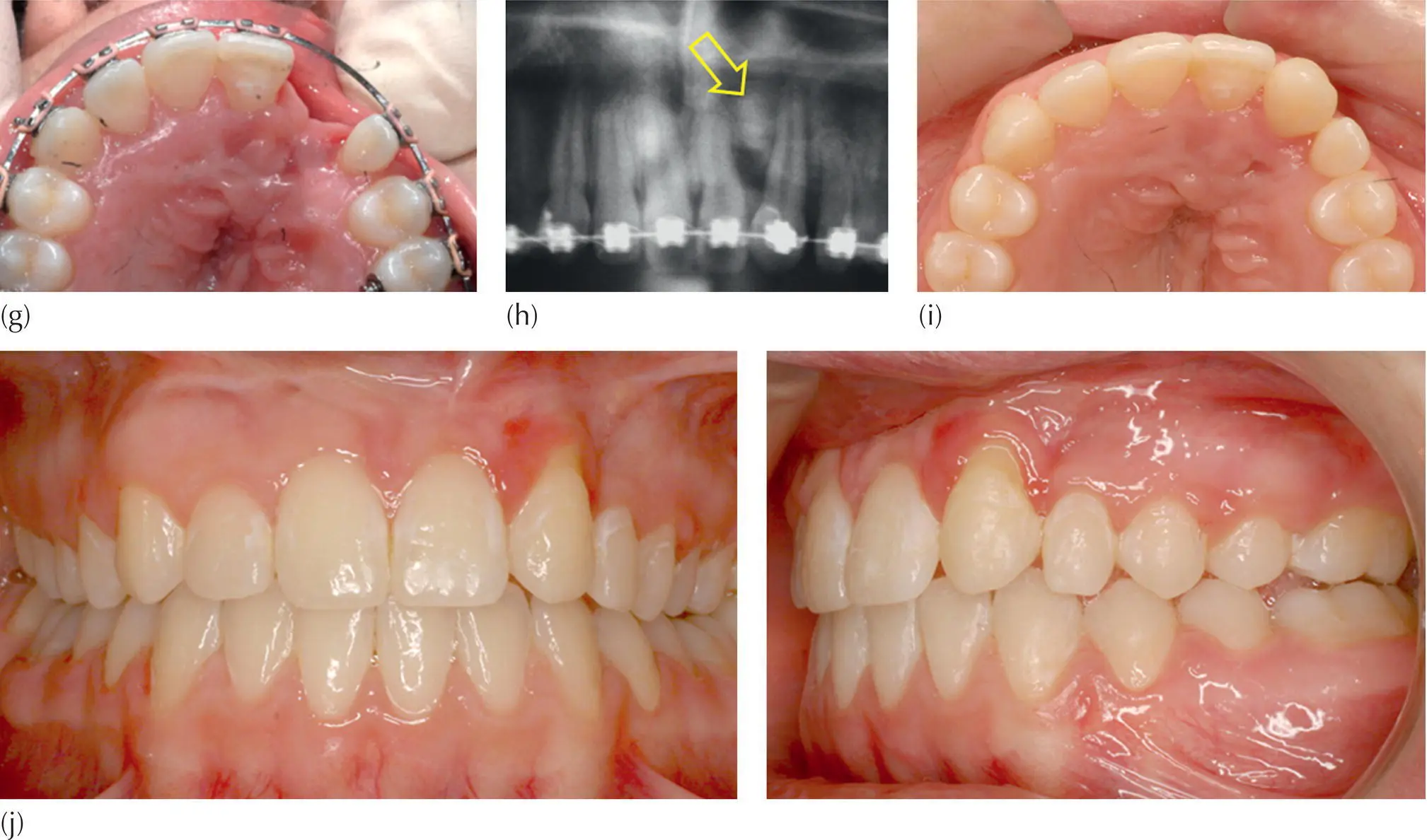 Fig 510 a The initial records of the dentition showing the narrowed - фото 70
