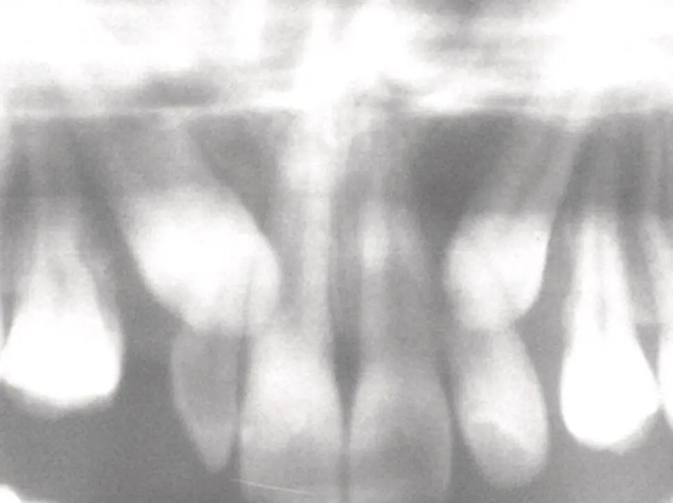 Fig 48 The enlarged premaxillary segment of a panoramic radiograph showing - фото 46