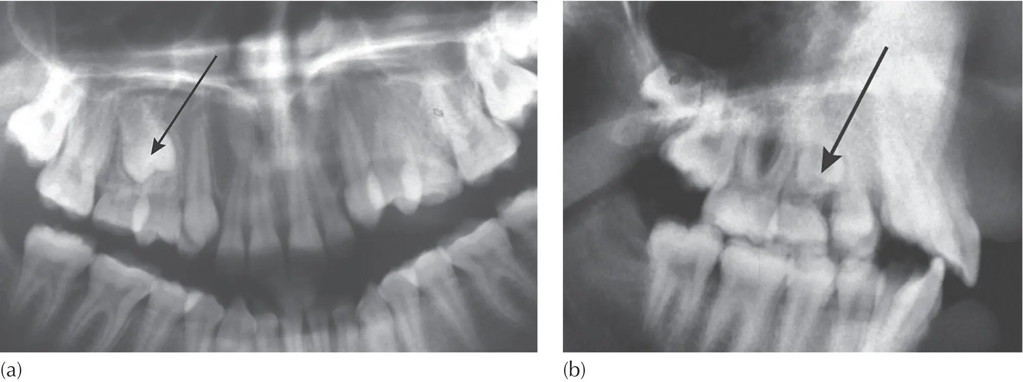 Fig 47 The lateral tube shift method using a panoramic radiograph and a - фото 45