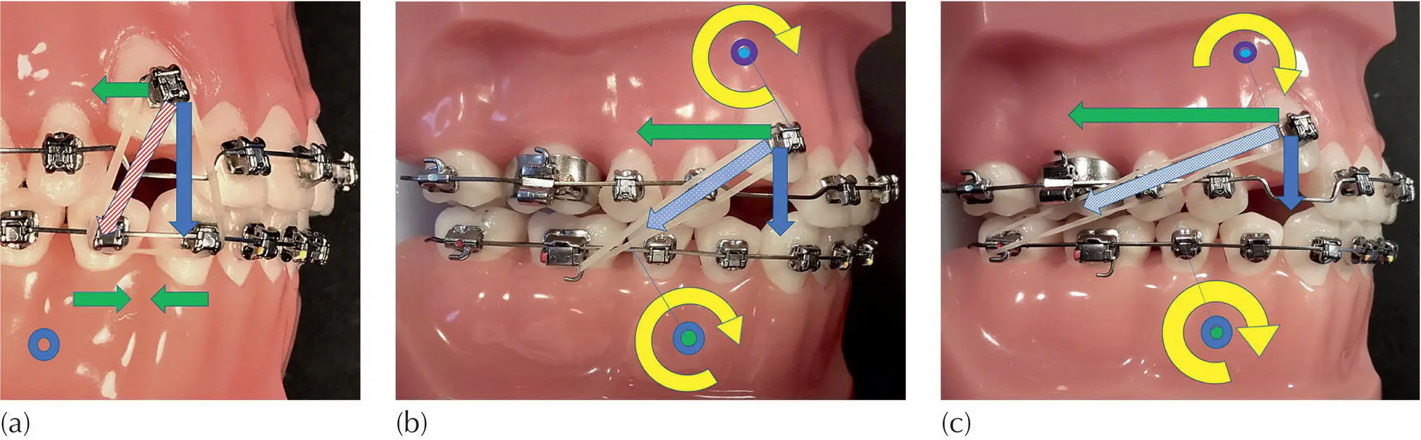 Fig 37 a Short vertical elastics exhibit a greater vertical component of - фото 28