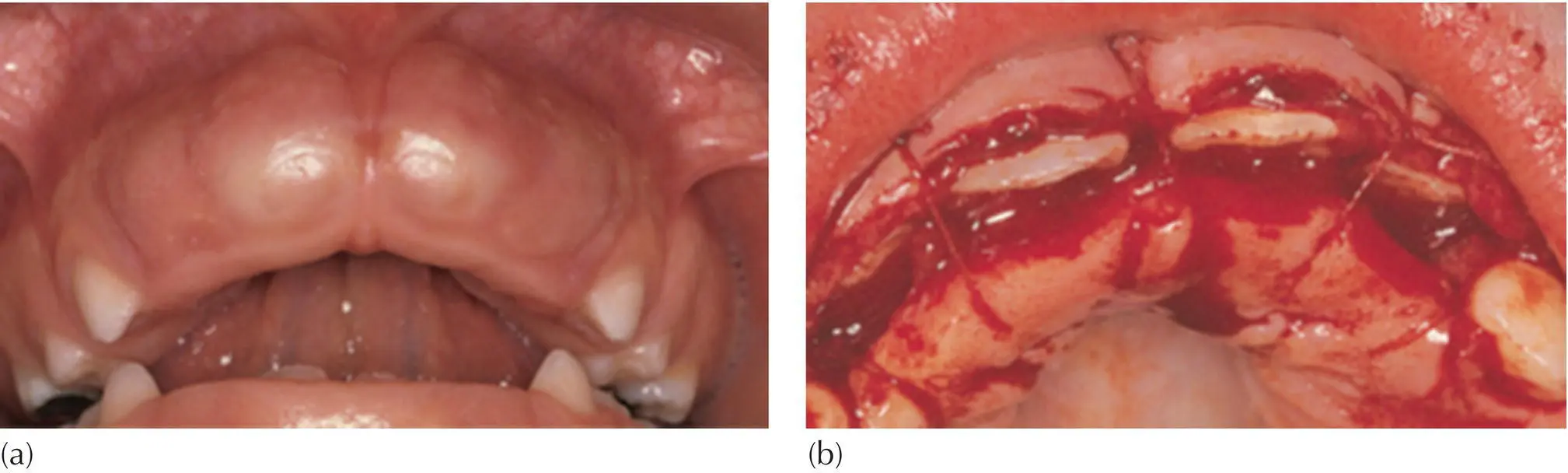 Fig 52 a Soft tissue impaction of maxillary central incisors b Apical - фото 61