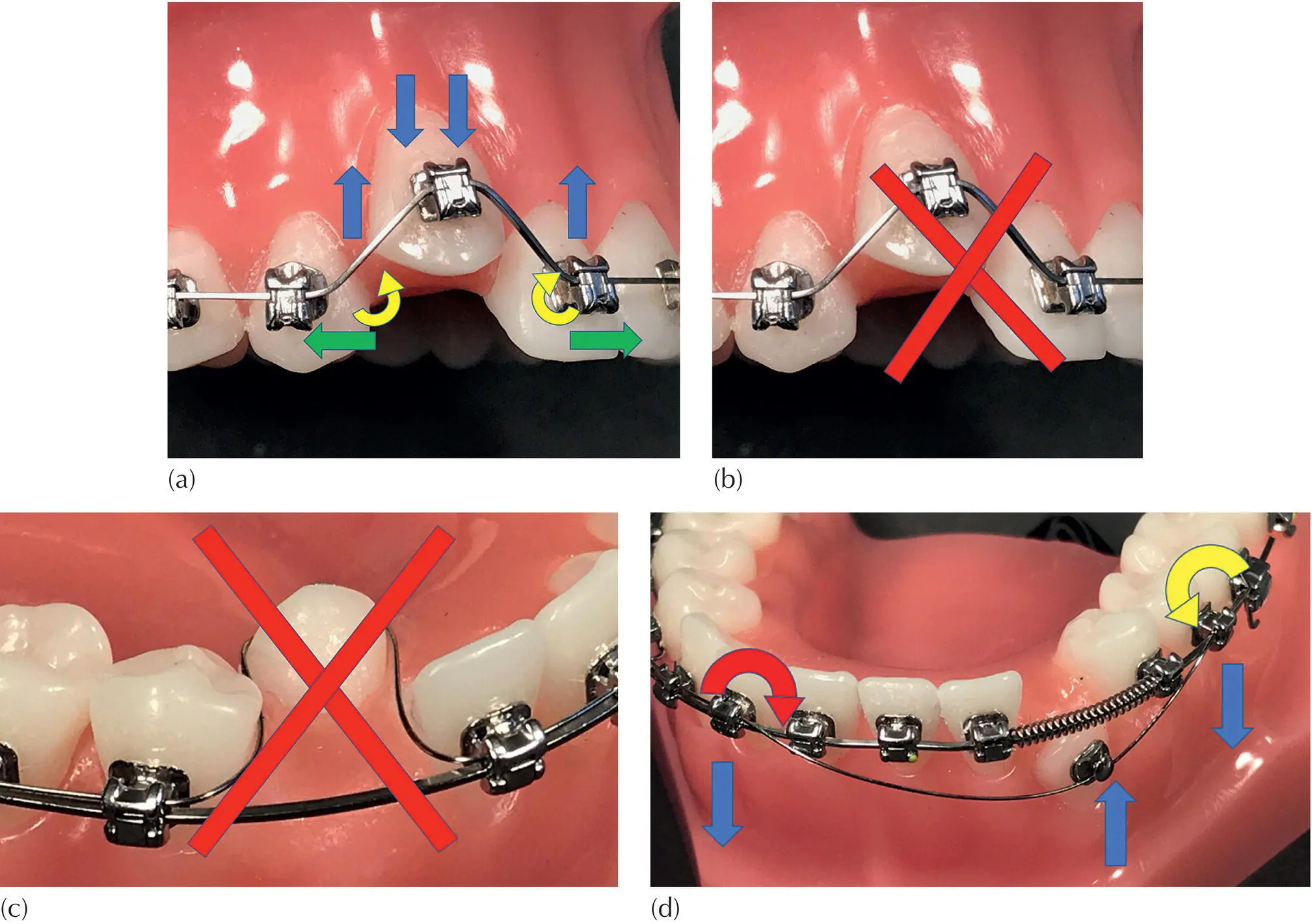 Fig 39 a When aligning a high canine using a continuous and fully engaged - фото 30