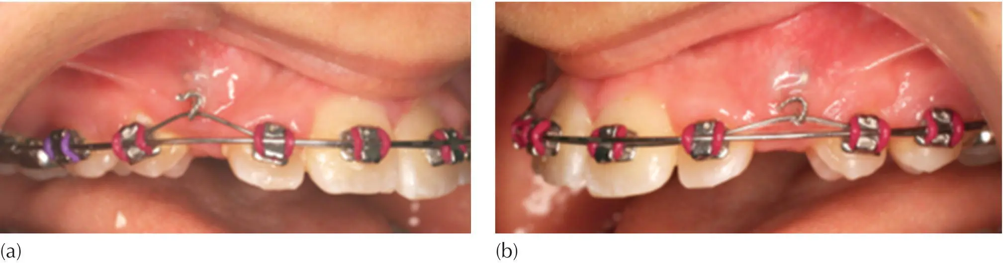 Fig 27 a b The use of nickeltitanium auxiliary wire as the active element - фото 18