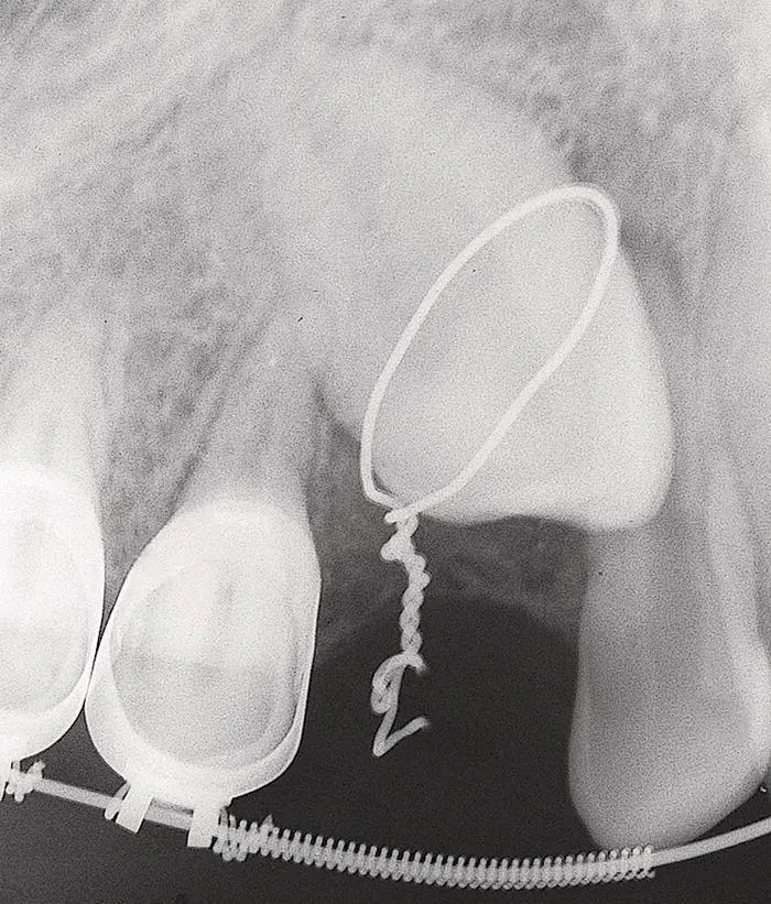 Fig 21 Lasso wire encircling the neck of an impacted canine circa 1971 - фото 12