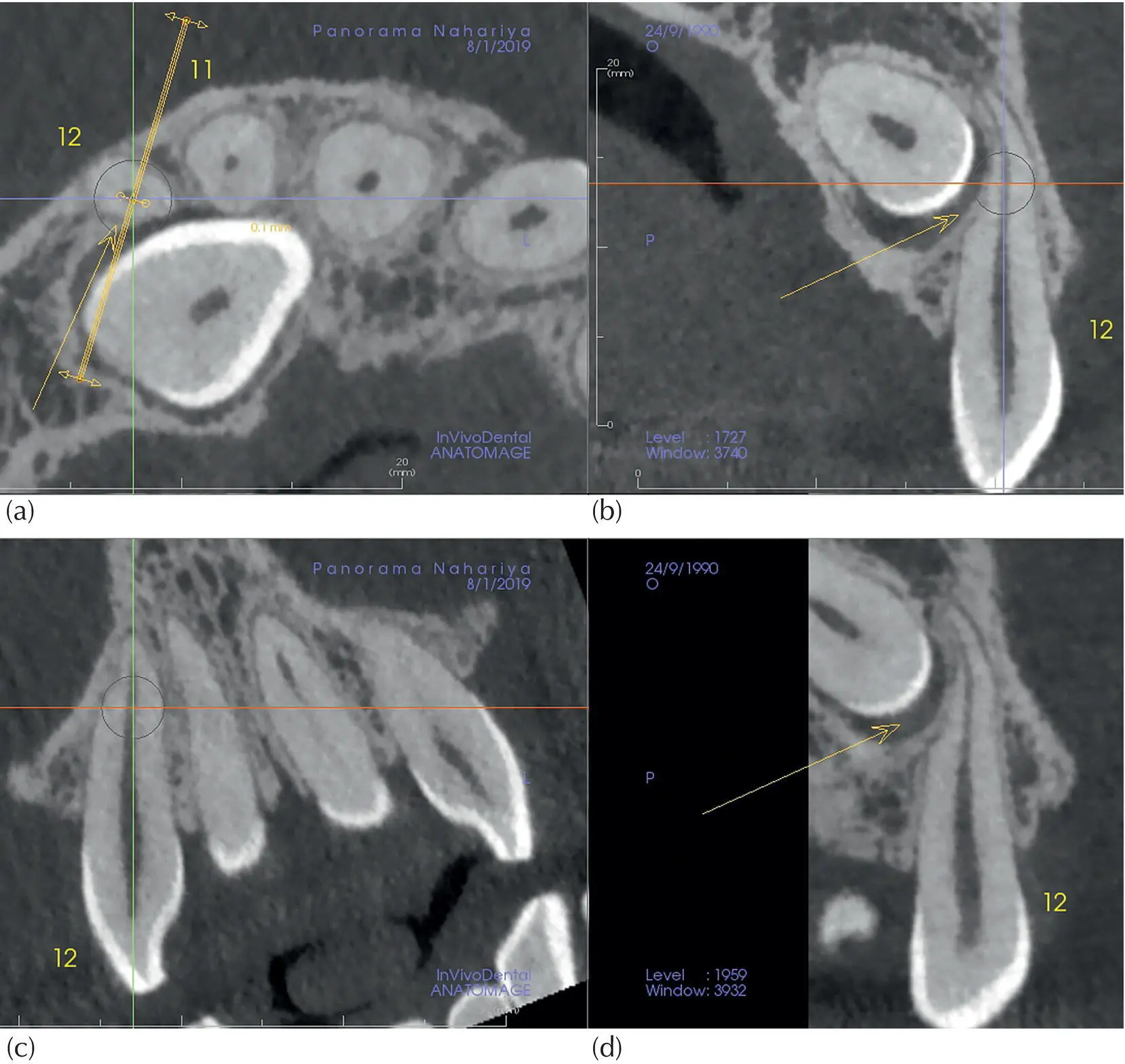 Fig 417 Diagnosing resorption with multiplanar reconstruction The long axis - фото 55