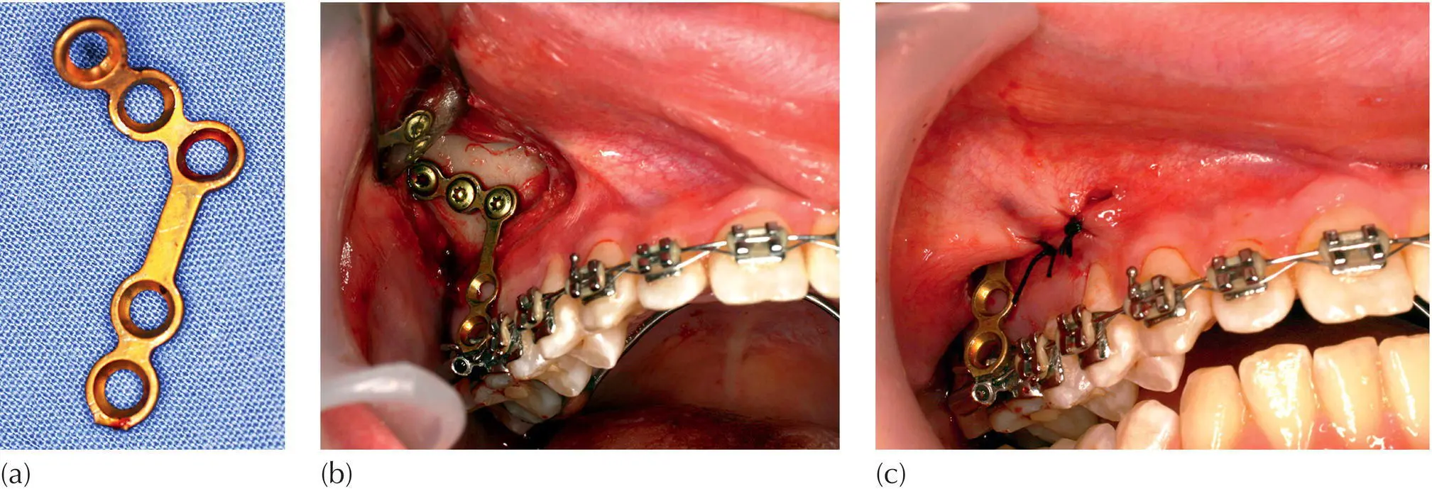 Fig 29 Zygomatic plate a An onplant plate b The plate is held in place - фото 20