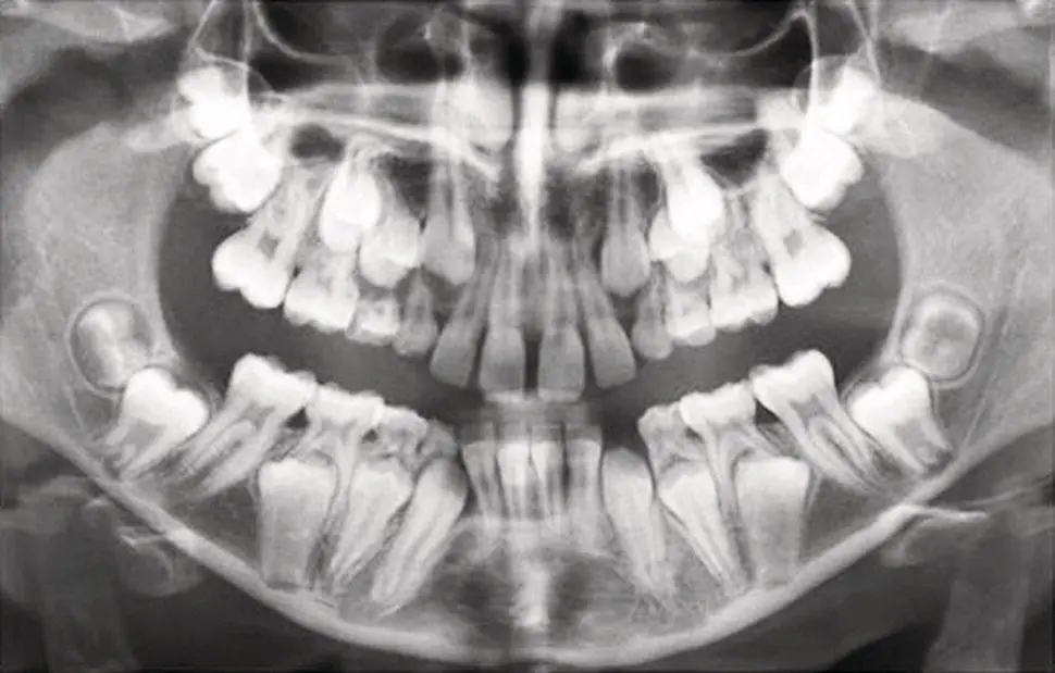 Fig 11 The advanced root development of the canines and premolars indicates a - фото 3