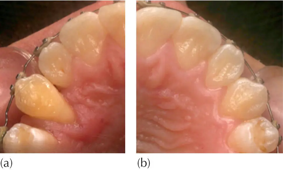 Fig 58 Treatment for the right palatally impacted canine was performed with - фото 67