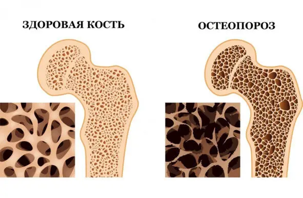 В возрасте старше 60 лет обнаруживаются изменения в сосудах суставной капсулы - фото 2