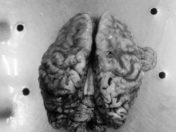 Рис 28 Признаки болезни Альцгеймера атрофия коры выраженная гидроцефалия - фото 37