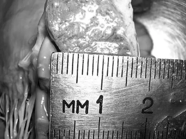 Рис 34 Гипертрофия миокарда левого желудочка Рис 35 Признаки ХСН - фото 44