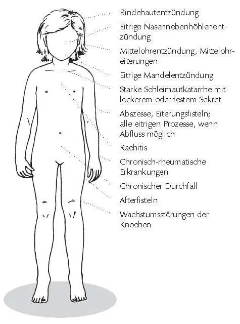 Mangelan Calcium sulf zeigt sich in Abszessen Eiterungsfisteln und - фото 15