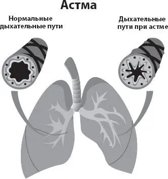 Астма это хроническое воспалительное заболевание нижних дыхательных путей - фото 10
