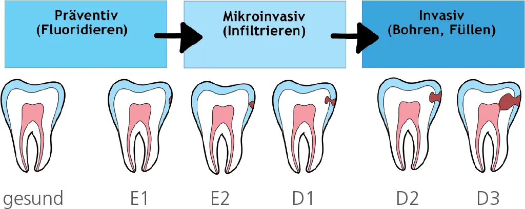 Abb 2 Bohrerloses Behandlungsschema Das Zahnbein auch Dentin genannt - фото 20