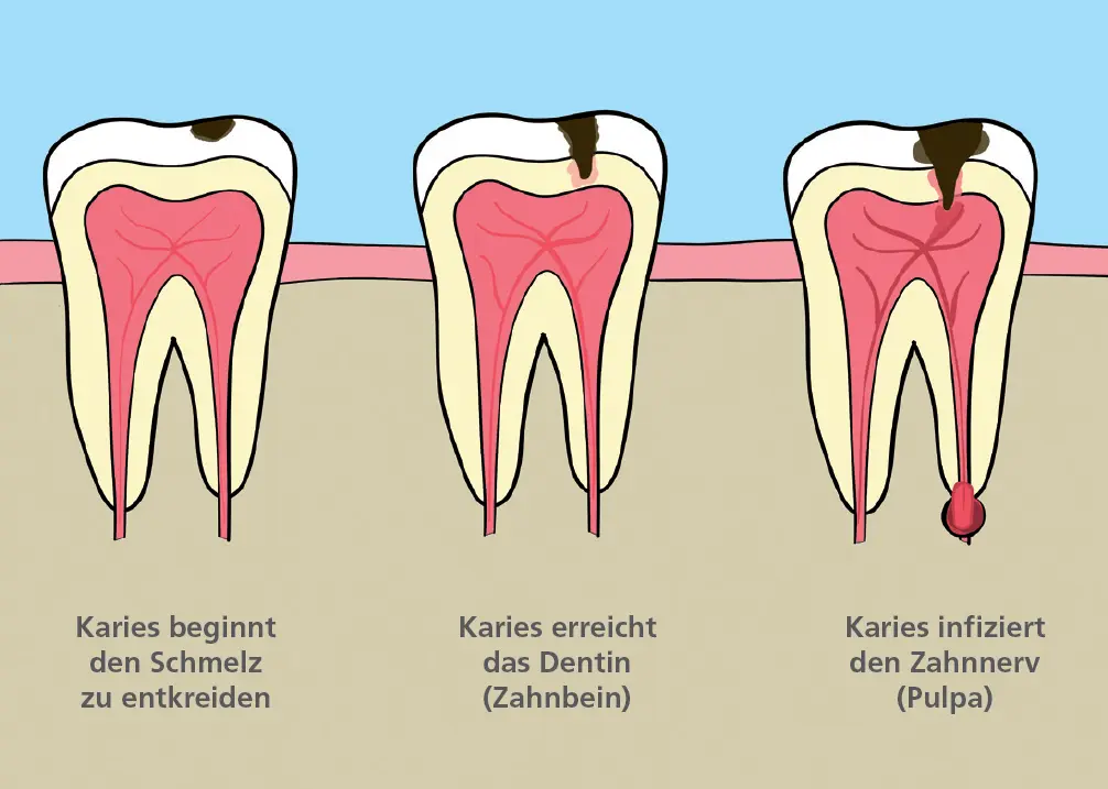 Abb 1 Das Fortschreiten der Karies Stufe 1 Initialkaries Die Bakterien - фото 19