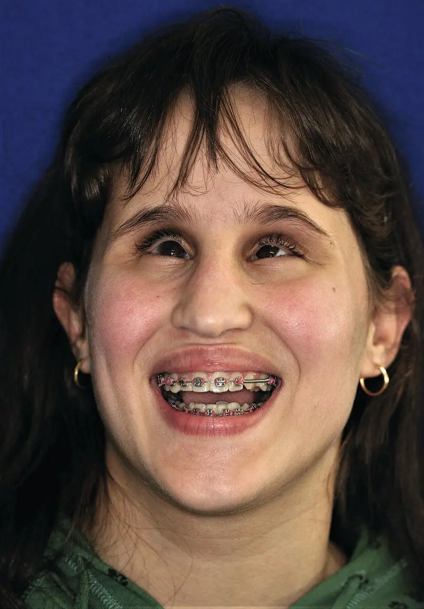 Figure 313 Orthodontic treatment for a patient with visual impairment - фото 16