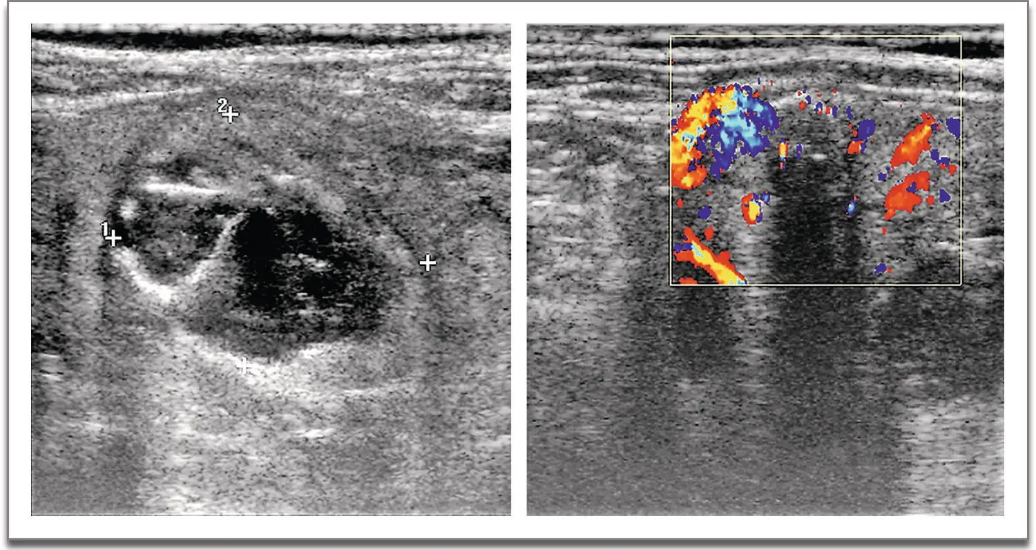 Figure 524 Greyscale ultrasound and colour Doppler sonogram showing multiple - фото 17