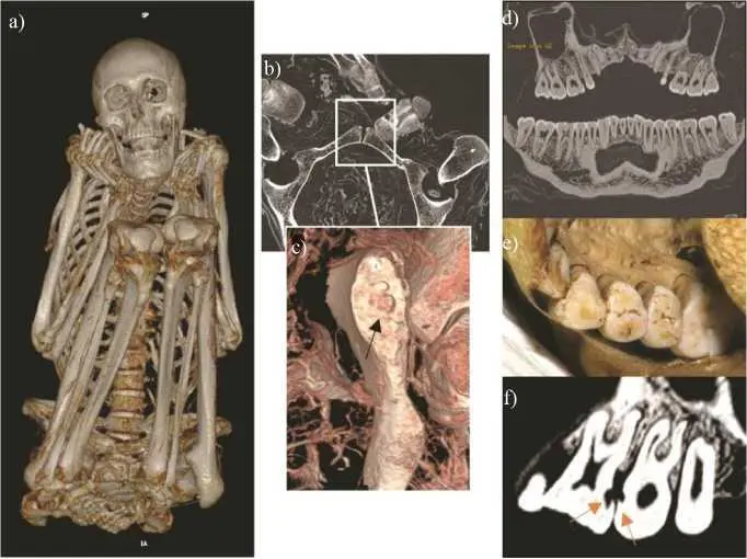 Figure 46 Osteodental condition of mummy MNHNHA30187 COMMENT ON FIGURE - фото 12