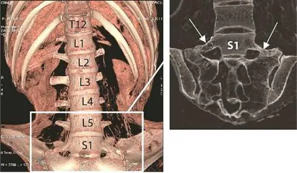 Figure 47 Coronal section and 3D reconstruction of the lumbosacral junction - фото 13
