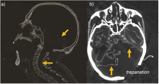Figure 48 a Sagittal and b axial sections showing intracranial and - фото 14