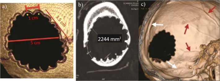 Figure 412 a and b Trepanation measurements c Endocranial view of the - фото 18