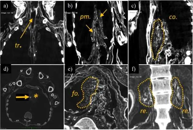 Figure 49 Chest CT images a Coronal section of the trachea tr b - фото 15