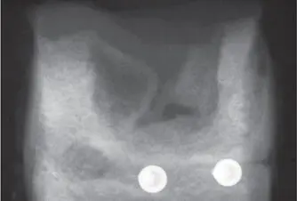 Fig 229Radiograph of a membranecovered defect after 2 months shows bony - фото 95