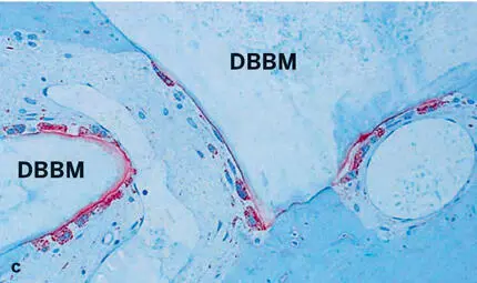 Fig 239Histologic sections of human biopsy specimens grafted with DBBM thin - фото 108