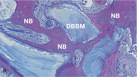 Fig 243Histologic section of a human biopsy specimen harvested 74 months after - фото 115