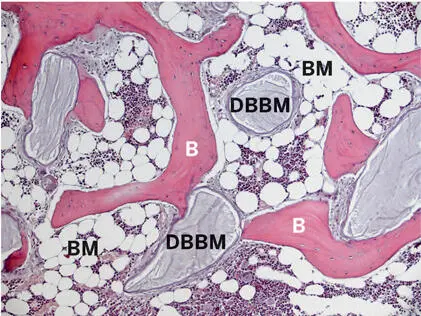 Fig 240Histologic section of a human biopsy specimen harvested 20 years after - фото 109