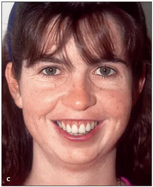 Essentials of Orthognathic Surgery - фото 16