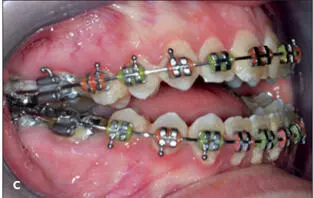 Essentials of Orthognathic Surgery - фото 156