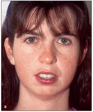 Essentials of Orthognathic Surgery - фото 14