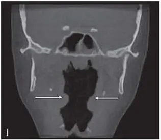 Fig 284This patient had severe OSA a Presurgical frontal view b - фото 163