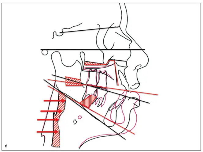 Essentials of Orthognathic Surgery - фото 157