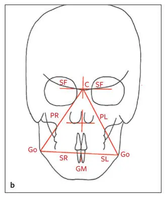 Fig 274 a Maxillary triangle b Mandibular triangle c Chin triangle and - фото 142