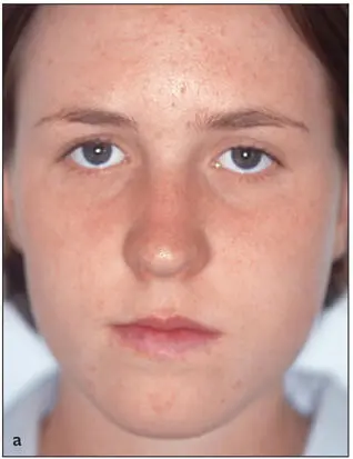 Fig 219Individual with vertical maxillary deficiency a It is not possible - фото 69