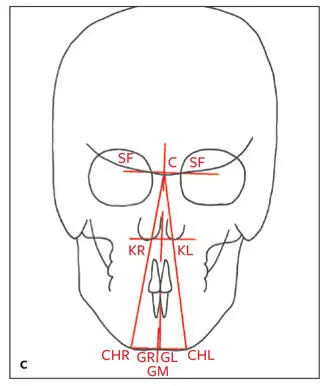 Fig 274 a Maxillary triangle b Mandibular triangle c Chin triangle and - фото 143