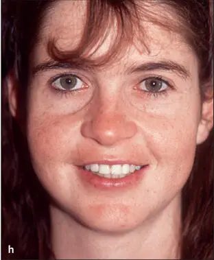 Fig 14This 20yearold patient was referred to the surgeon with the main - фото 21
