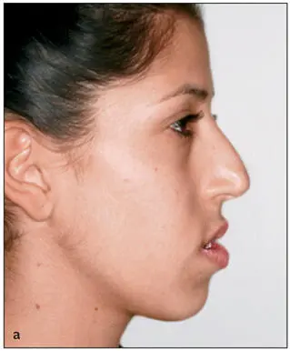 Fig 221Corrective facial changes following orthognathic surgery may have a - фото 72