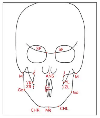 Fig 272Posteroanterior hard tissue cephalometric landmarks Sphenofrontal - фото 139