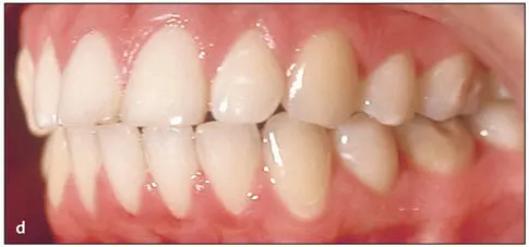 Essentials of Orthognathic Surgery - фото 17