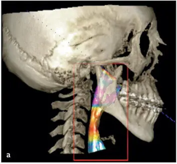 Fig 285Patients with high mandibular plane angle Class III occlusion treated - фото 164