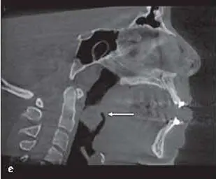 Essentials of Orthognathic Surgery - фото 158