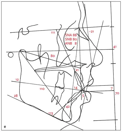 Essentials of Orthognathic Surgery - фото 18