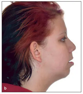 Essentials of Orthognathic Surgery - фото 155