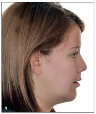Fig 284This patient had severe OSA a Presurgica - фото 161
