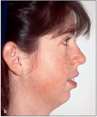 Essentials of Orthognathic Surgery - фото 15