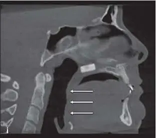 Fig 284This patient had severe OSA a Presurgical frontal view b - фото 162